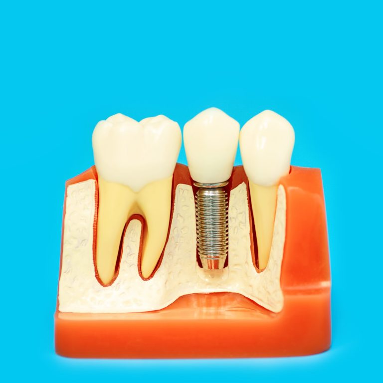 medical model of the jaw with false teeth on a pin on a blue background